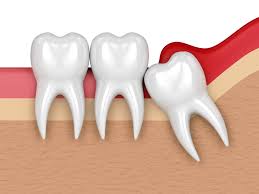  WISDOM TOOTH 
